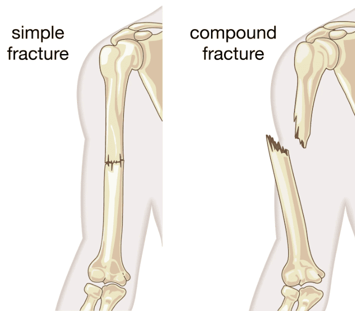 bone-compound-fracture-skin