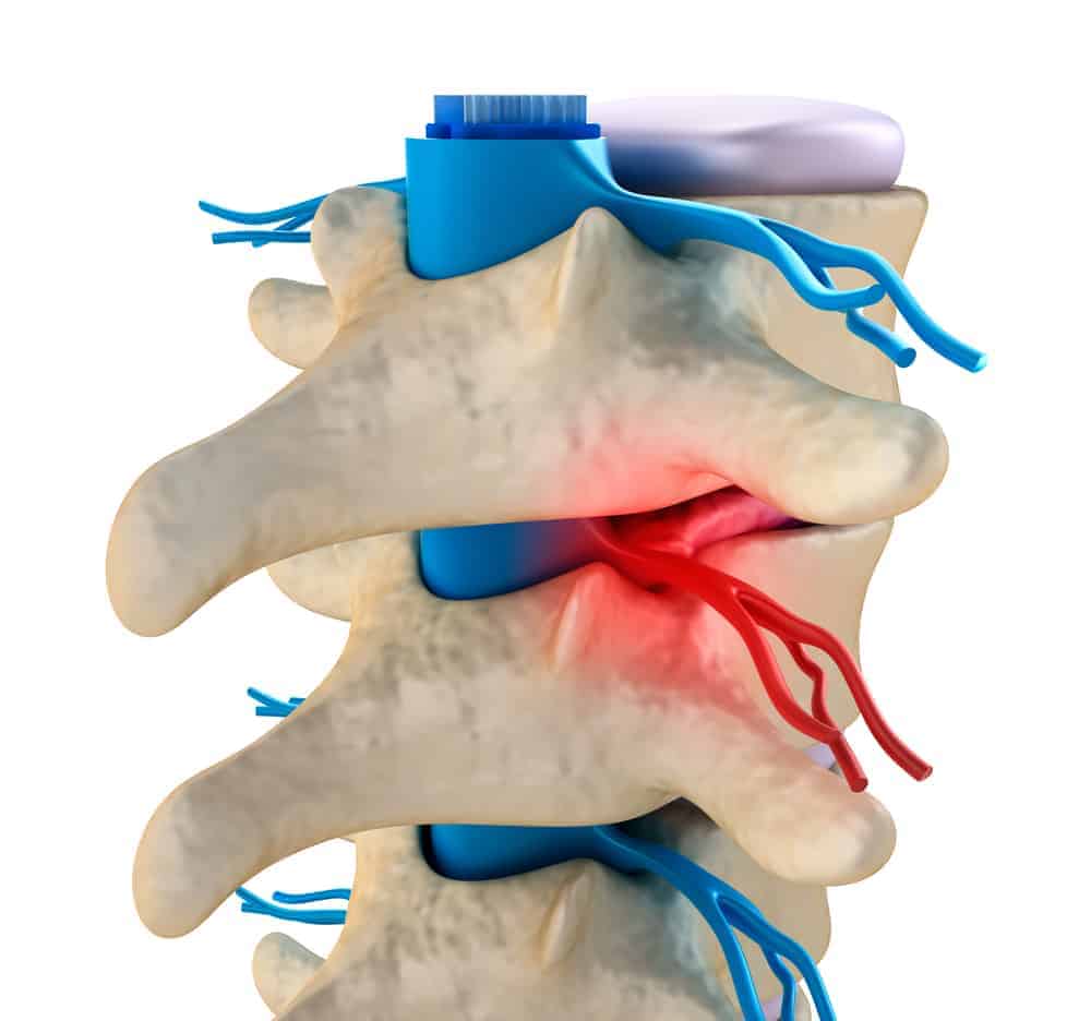 close up of pinched nerve pain