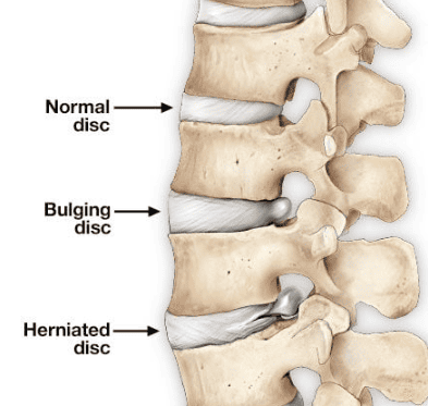 two main types of spinal disc injuries